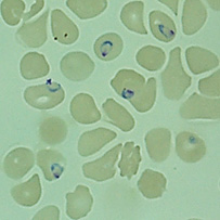 Red blood cells infected with malaria