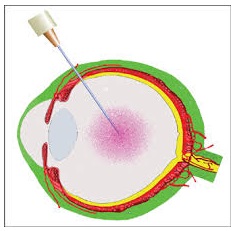 Schematic illustration of intravitreal injection​