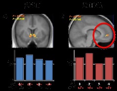 Two bar graphs and an MRI scan of a brain