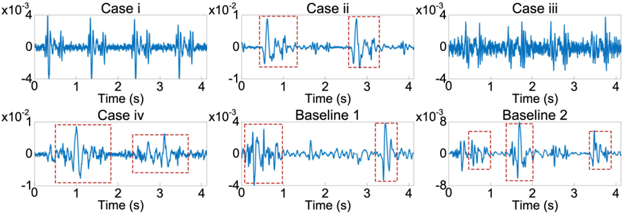 Figure 2: Snapshots of PCG under the four cases (left ear) and two baselines, with interferences of walking highlighted with red dotted lines. Case i indicates the performance of EarPCG.