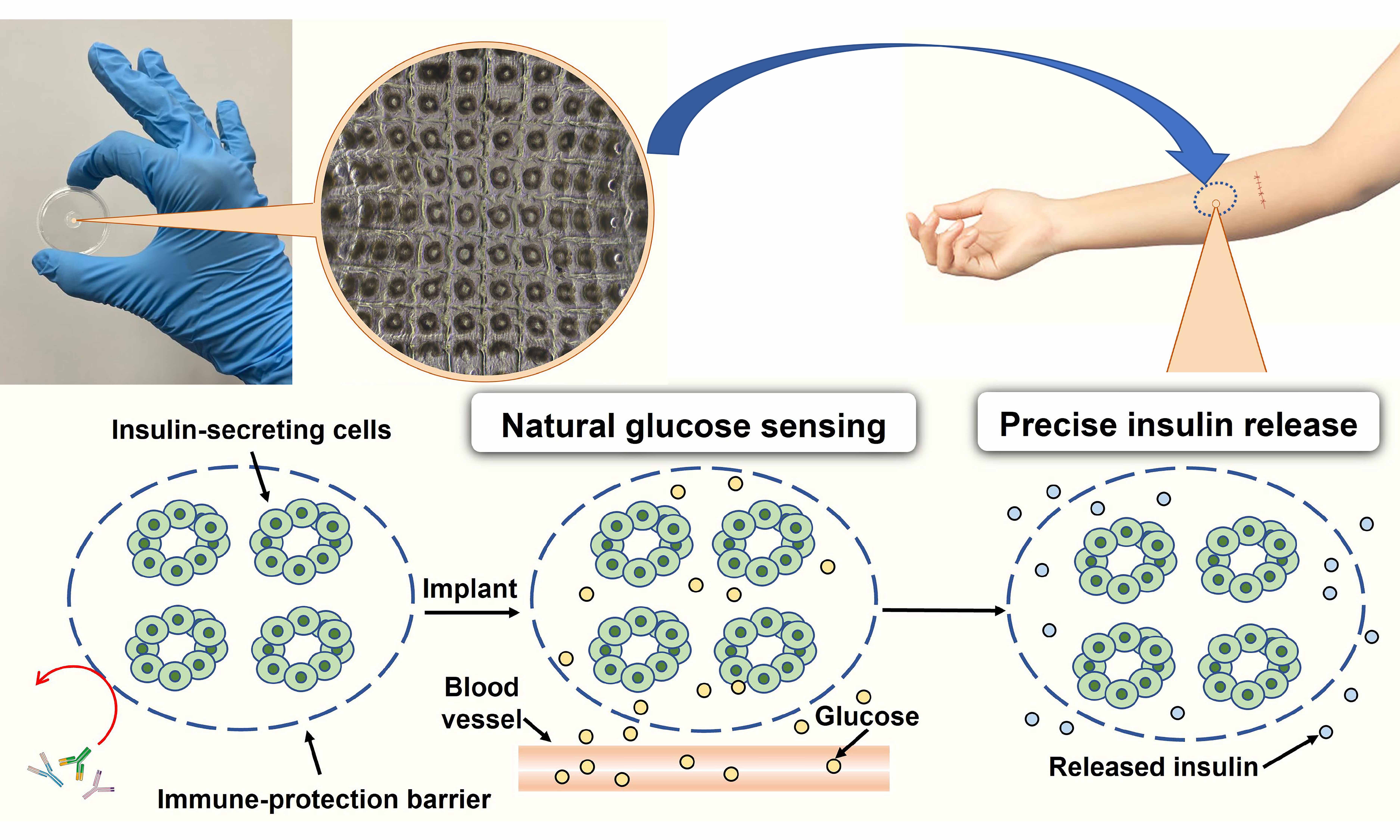 How the diabetes implant works to control blood glucose levels