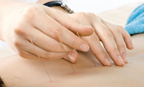 Acupuncture